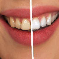 ホワイトニングでは歯の色に注意が必要です